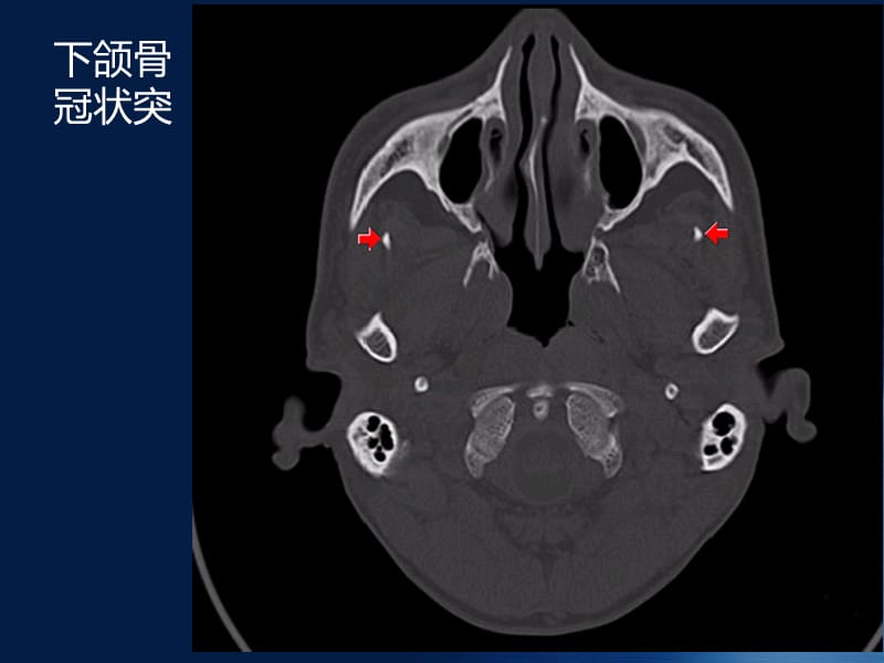 颅底骨质解剖.ppt_第2页