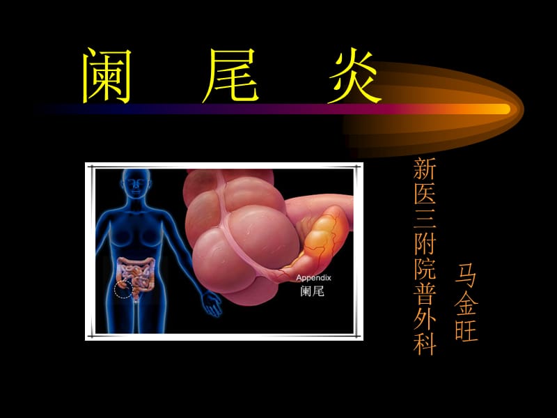 阑尾炎 ppt课件.ppt_第1页