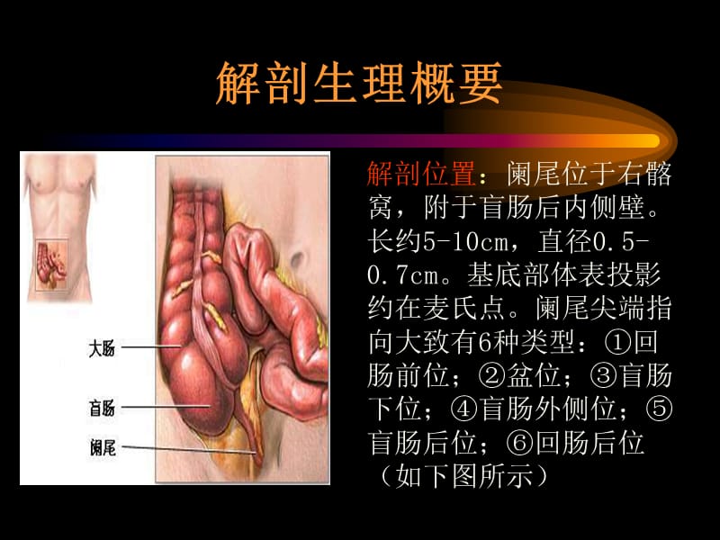 阑尾炎 ppt课件.ppt_第3页