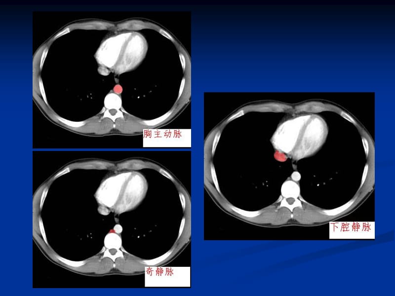 腹部CT解剖.ppt_第2页