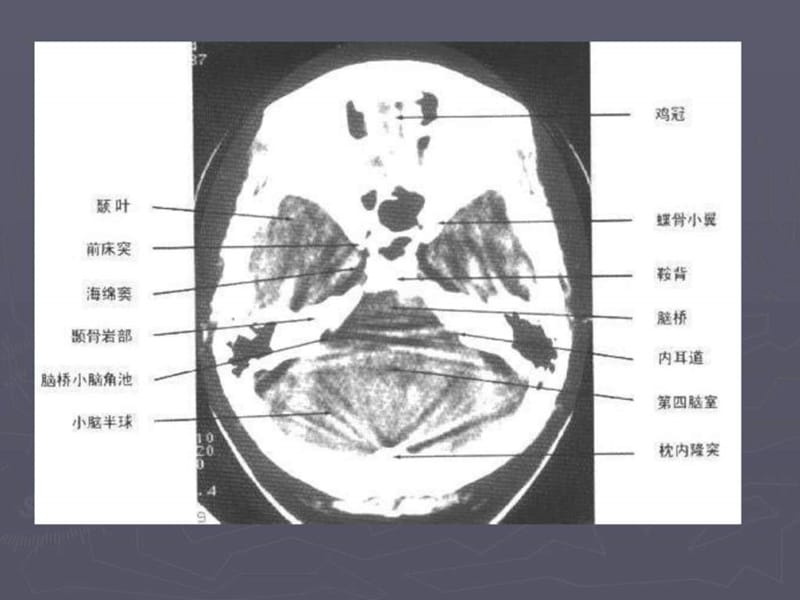 脑出血(Cerebral hemorrhage)_图文.ppt.ppt_第2页