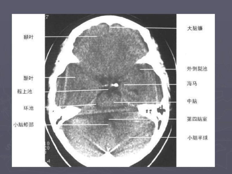 脑出血(Cerebral hemorrhage)_图文.ppt.ppt_第3页