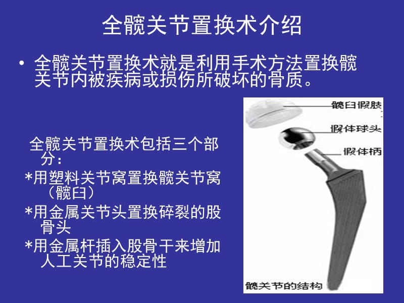 全髋关节置换术病.ppt_第2页