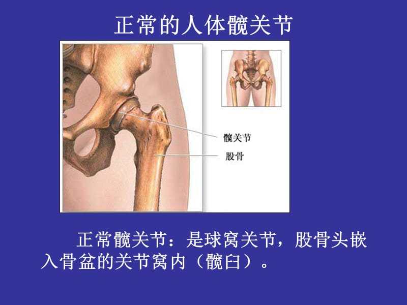 全髋关节置换术病.ppt_第3页