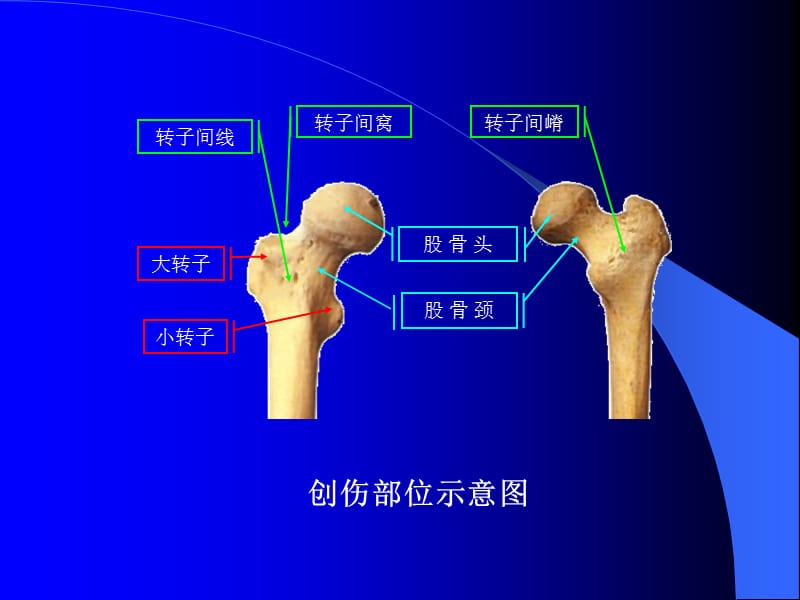 股骨转子间骨折.ppt_第3页