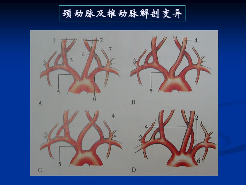 颈动脉疾病超声诊断.ppt_第3页