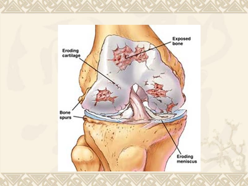 骨性关节炎.ppt_第2页