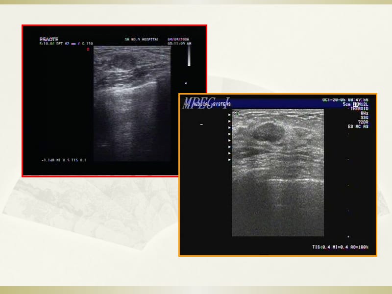 甲状腺超声诊断.ppt_第2页