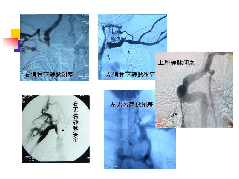 血透患者中心静脉病变的腔内治疗体会.ppt_第2页