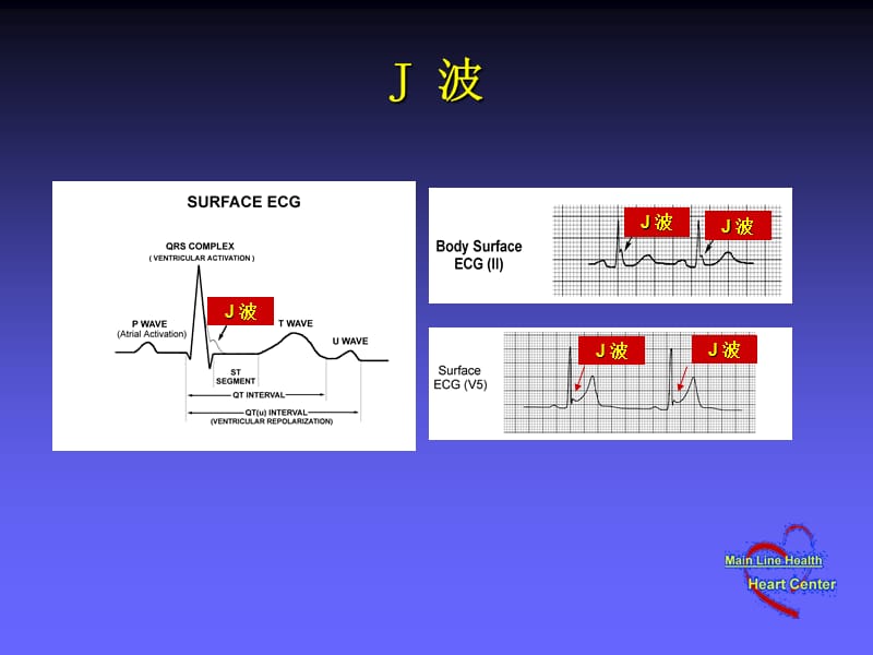 心电图J波.PPT_第2页