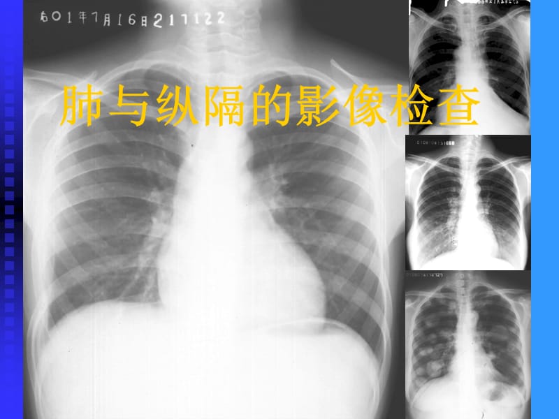 肺与纵隔的影像检查.ppt_第1页