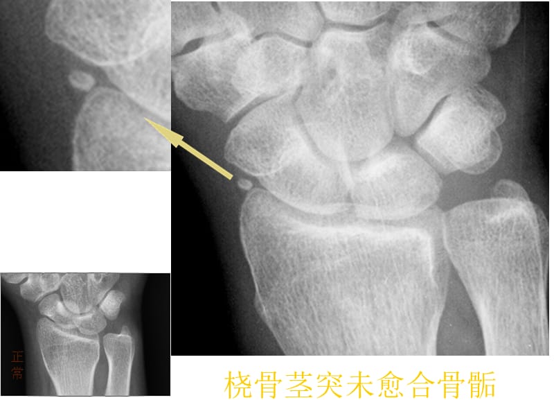 易误认为骨折的骨骺张晓春ppt课件.ppt_第2页