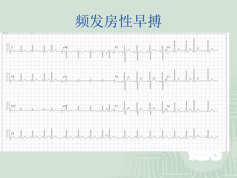 房性室性心律失常.ppt_第3页