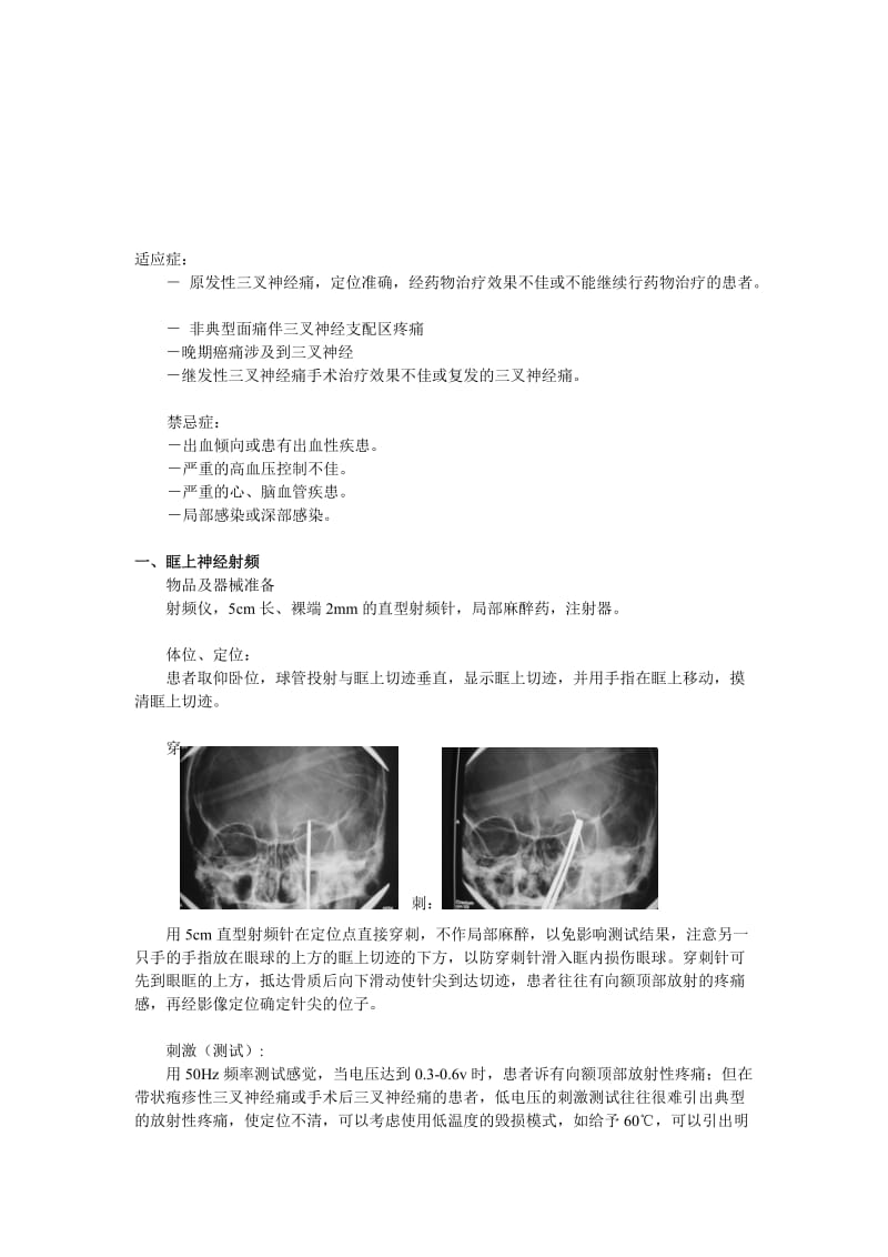 蒋劲-三叉神经痛的射频治疗.doc_第3页