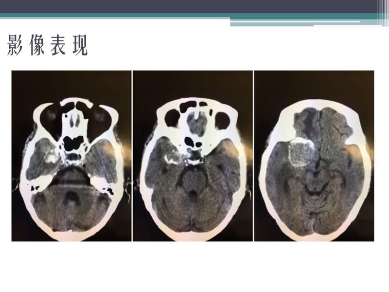 脑膜瘤的影像诊断与鉴别诊断ppt课件.ppt_第2页