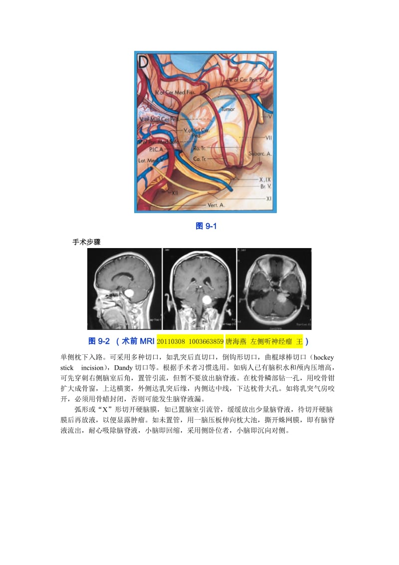 9听神经瘤手术.doc_第2页