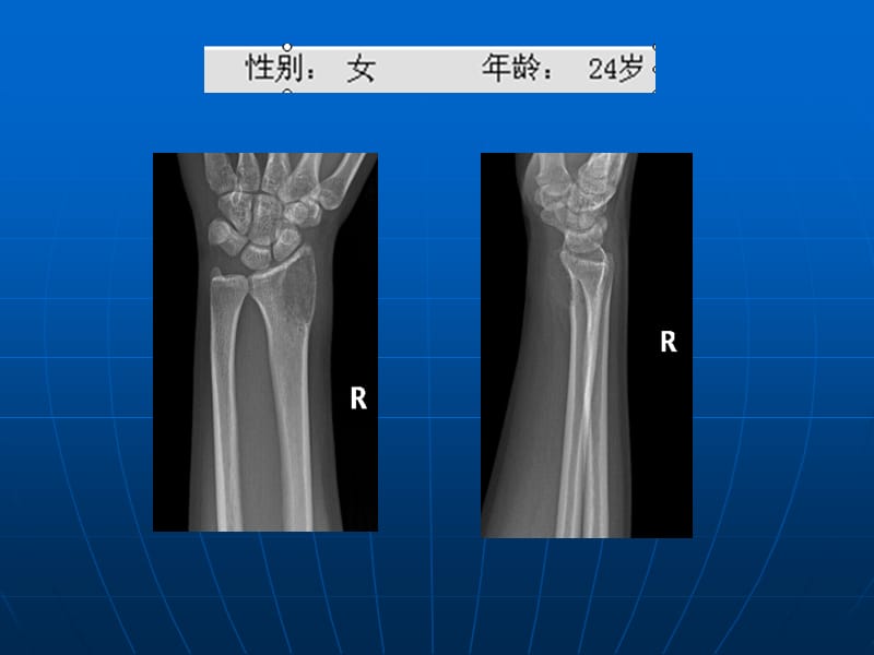 长骨偏心膨胀性病变诊断ppt课件.ppt_第2页