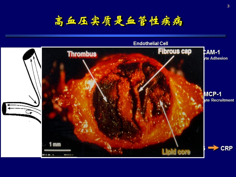 高血压抗栓治疗.ppt_第3页