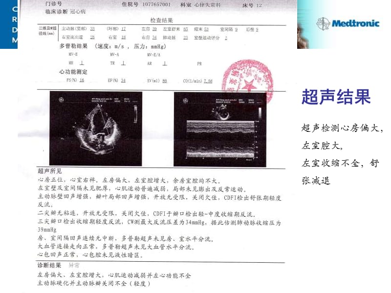 鞘中鞘植入冠状窦电极案例课件.ppt_第3页