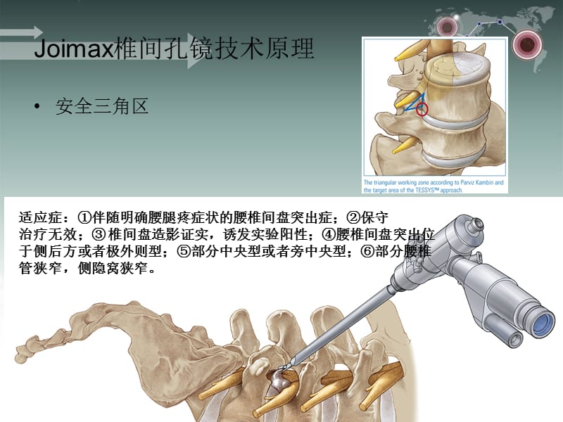 joimax椎间孔镜手术护理配合ppt课件.ppt_第3页