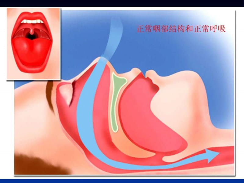 i阻塞性睡眠呼吸暂停综合征的诊治.ppt_第2页