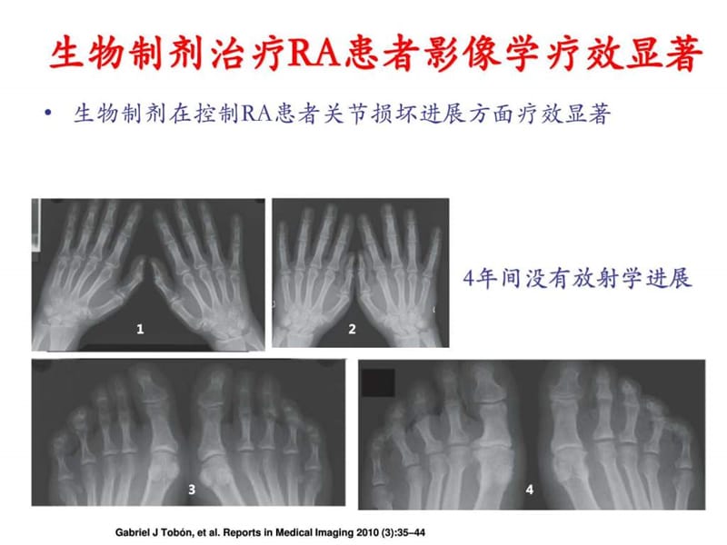 AS的治疗策略(1).ppt_第3页