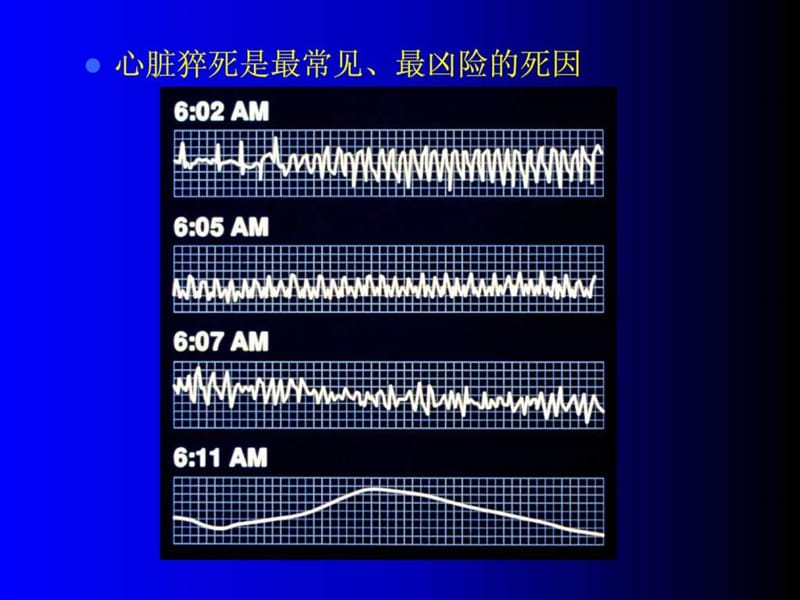 心脏骤停和心脏性猝死VF.ppt_第3页