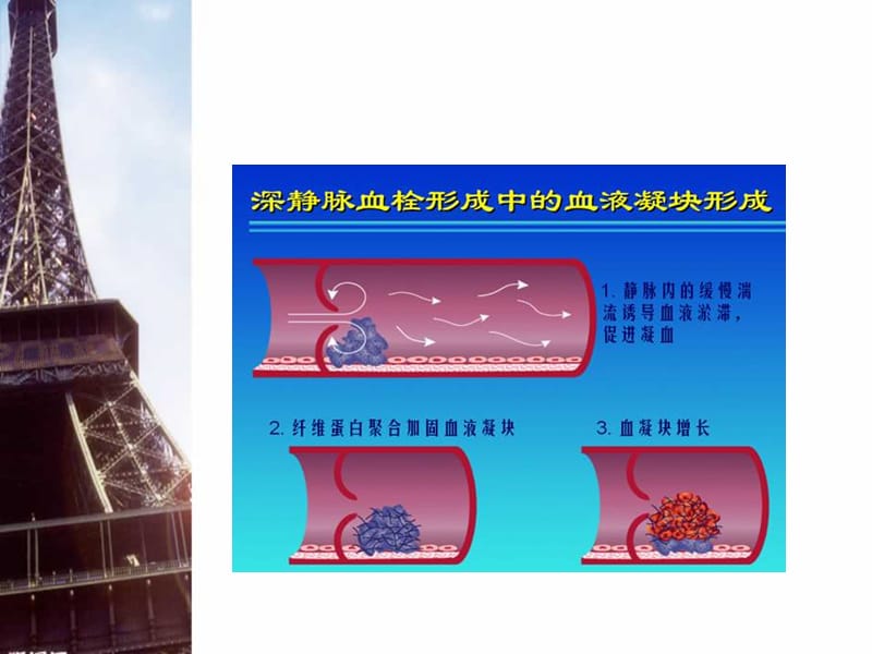 医学ppt--下肢深静脉血栓溶栓护理.ppt_第3页