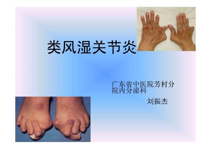 中西结合7年制教材(大量图片)类风湿性关节炎.ppt_第1页