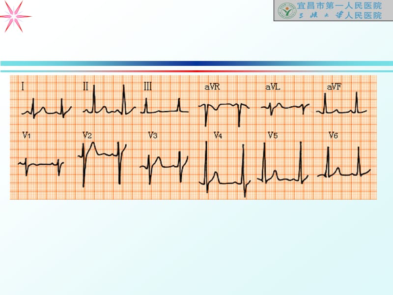 《心电图讲义1》ppt课件.ppt_第2页