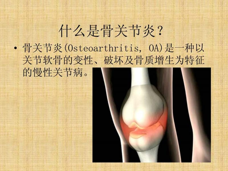 骨关节炎与骨质疏松症.ppt_第3页