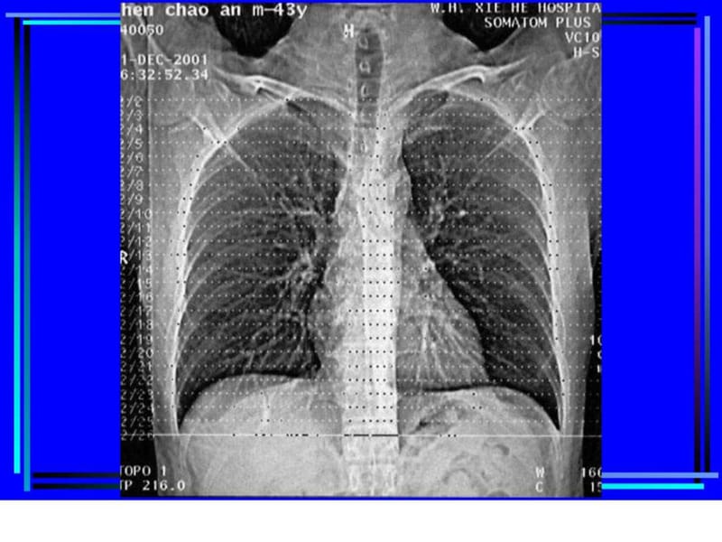 胸部CT诊断(大量实例CT片)_临床医学_医药卫生_专业资料.ppt_第3页