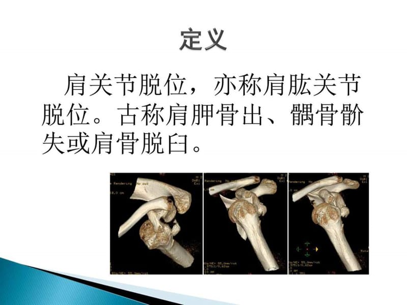 肩关节脱位最新进展研究.ppt_第3页