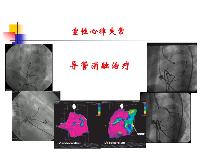 室性心律失常非药物治疗策略选择刘同宝ppt课件.ppt_第3页