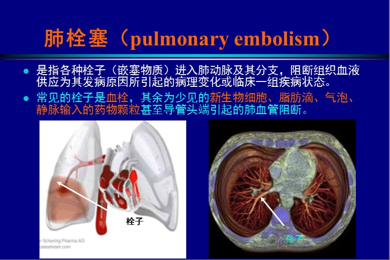 医学ppt--内科学肺栓塞教案.ppt_第3页