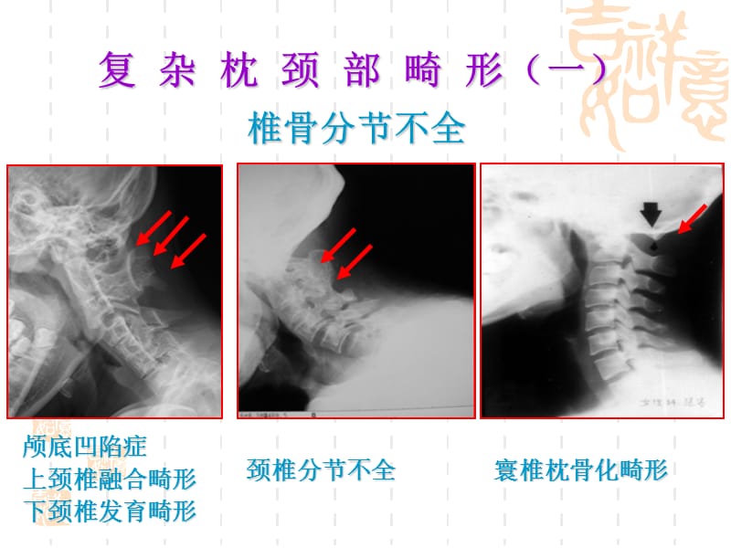 枕颈部发育畸形简略版白底板ppt课件.ppt_第2页