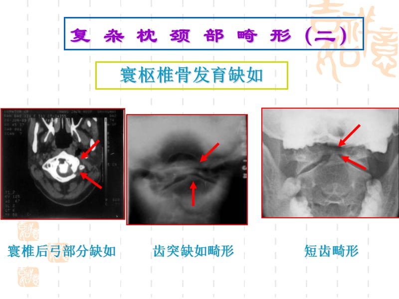 枕颈部发育畸形简略版白底板ppt课件.ppt_第3页