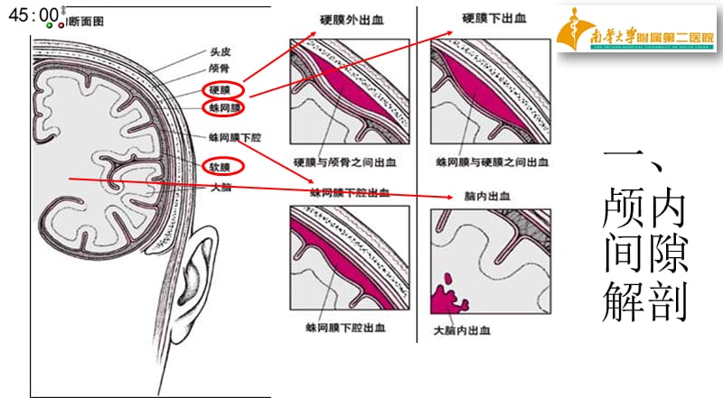 基层神经外科常见引流管介绍.ppt_第2页