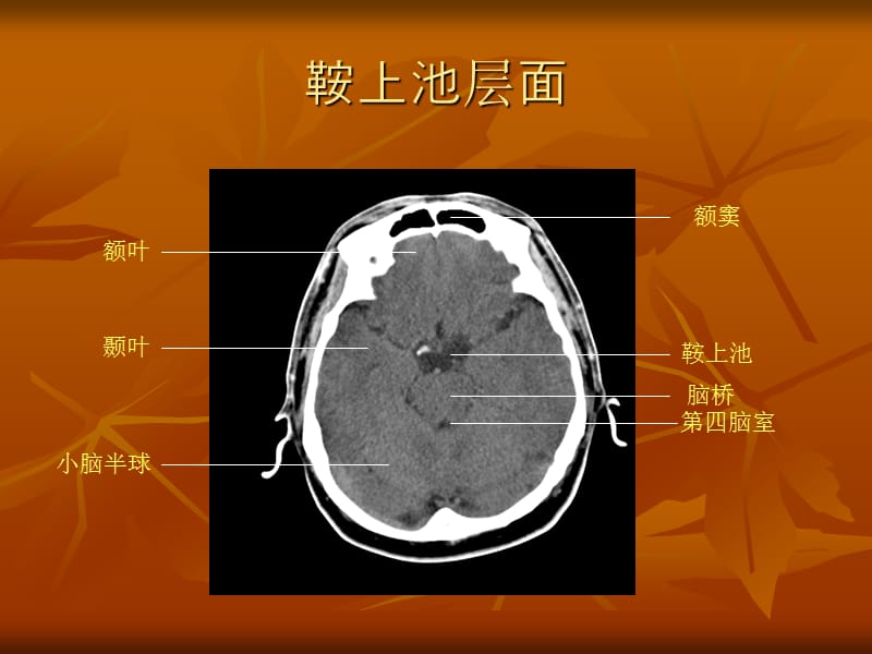 颅脑断层解剖PPT课件.ppt_第3页