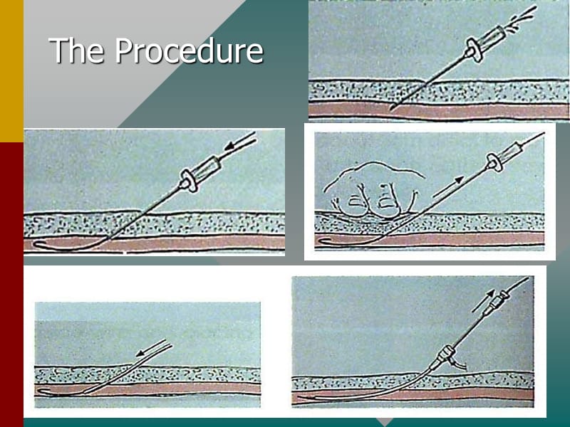 经皮穿刺冠心病介入治疗(pci)的回顾与展望_刘映峰.ppt_第3页