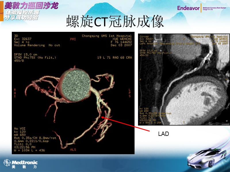 介入治疗病例讨论.ppt_第3页