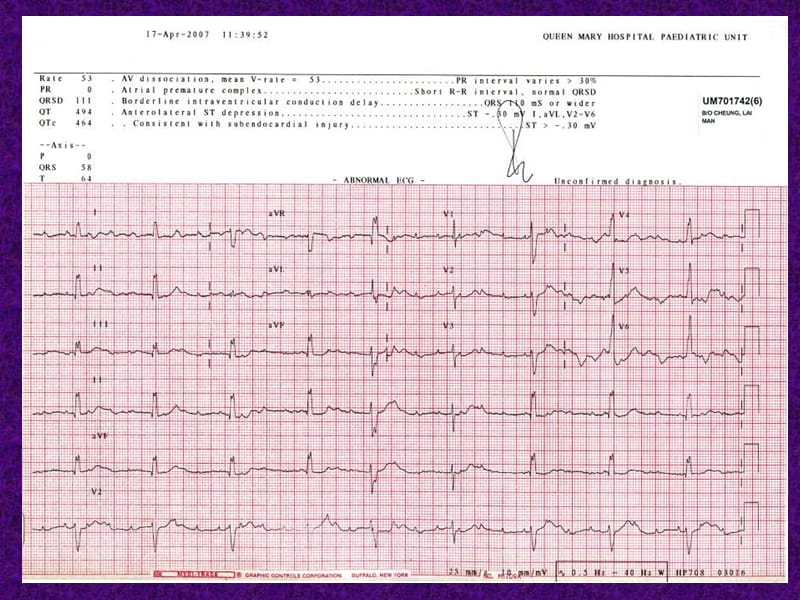 靠右心室起搏的婴儿产生了双心室起搏，由此导致了心力衰竭-病例（英文）.ppt_第3页