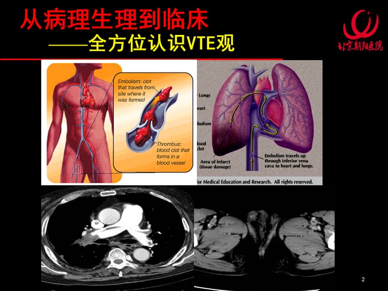 肺血栓栓塞症—— 必须关注的临床问题-课件，幻灯，PPT.ppt_第2页