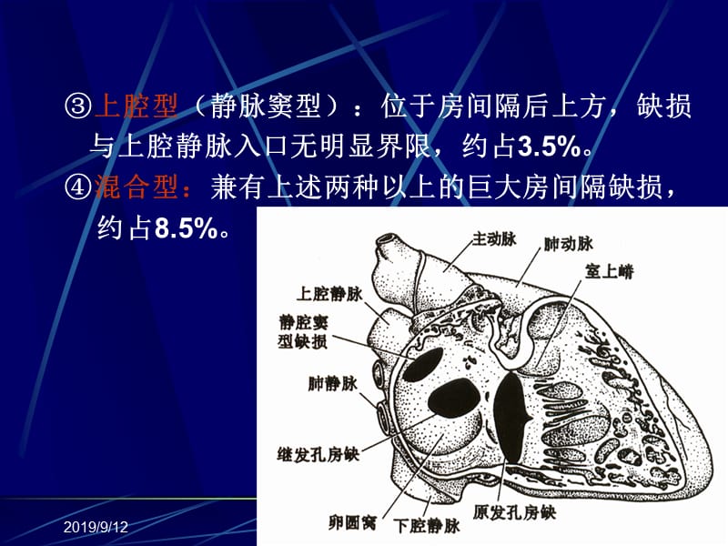 超声诊断学一先天性心脏病-影像学课件.ppt_第3页