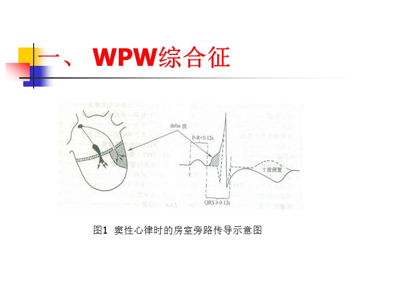 预激综合症及合并快速性心律失常的电生理与心电图特征.ppt_第3页