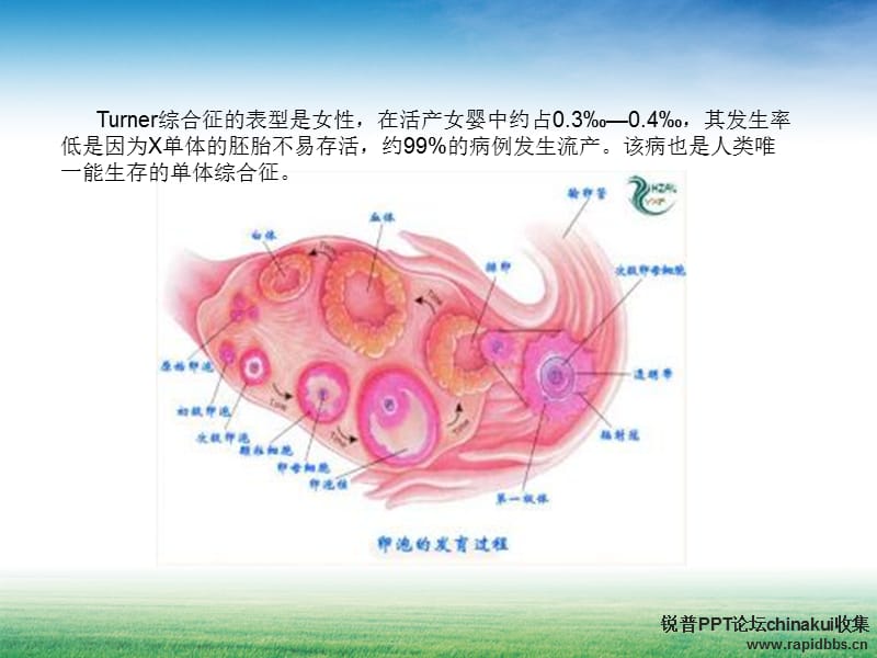 先天性卵巢发育不全综合征.ppt_第2页