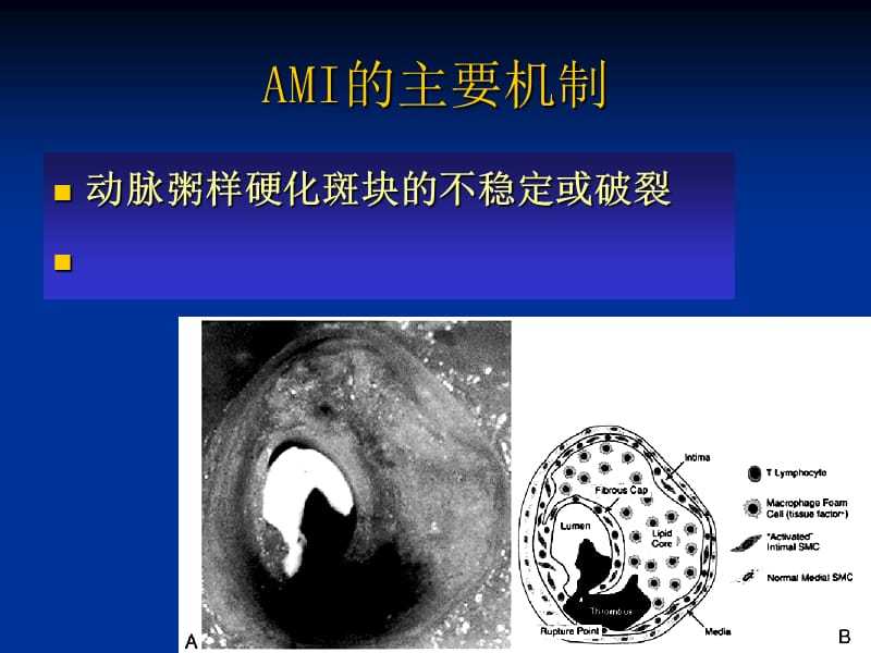 AMI的溶栓治疗2.ppt_第2页