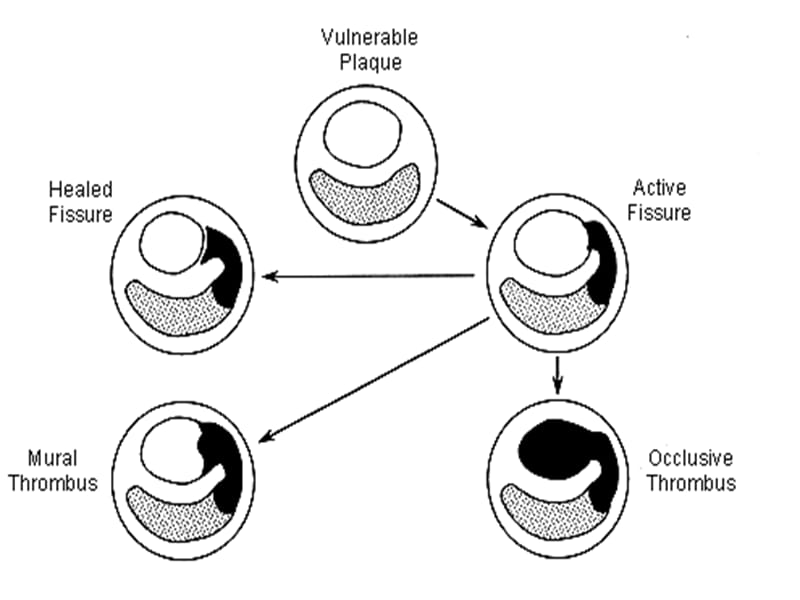 AMI的溶栓治疗2.ppt_第3页