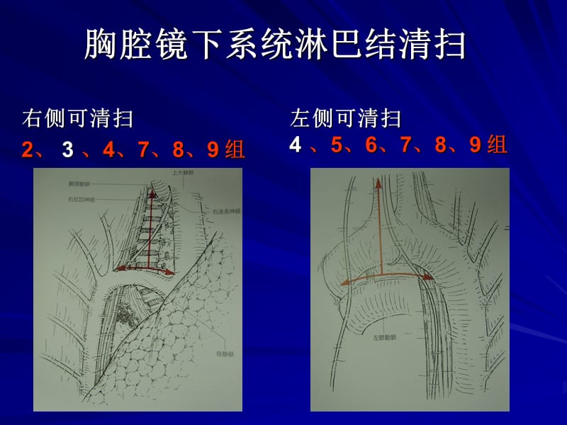 VATS肺癌淋巴结清扫.ppt_第2页