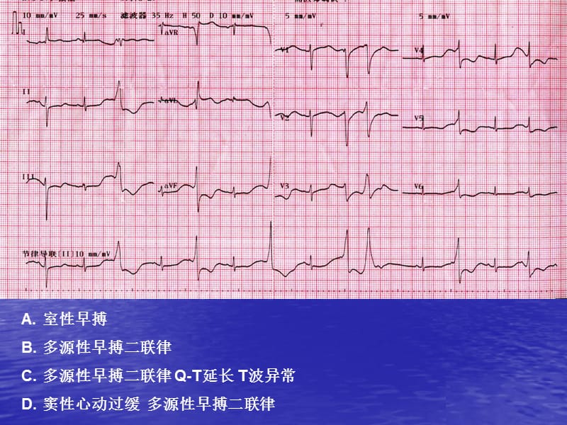 心电图考试练习.ppt_第3页